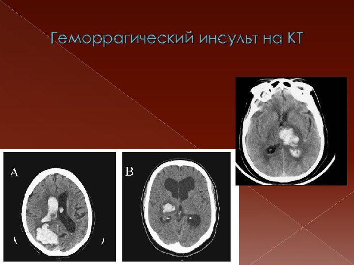 Геморрагический инсульт на КТ 