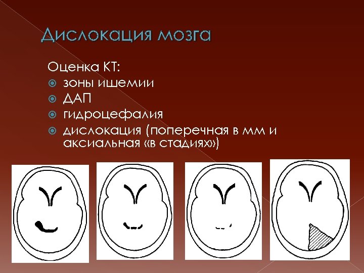 Дислокация мозга Оценка КТ: зоны ишемии ДАП гидроцефалия дислокация (поперечная в мм и аксиальная
