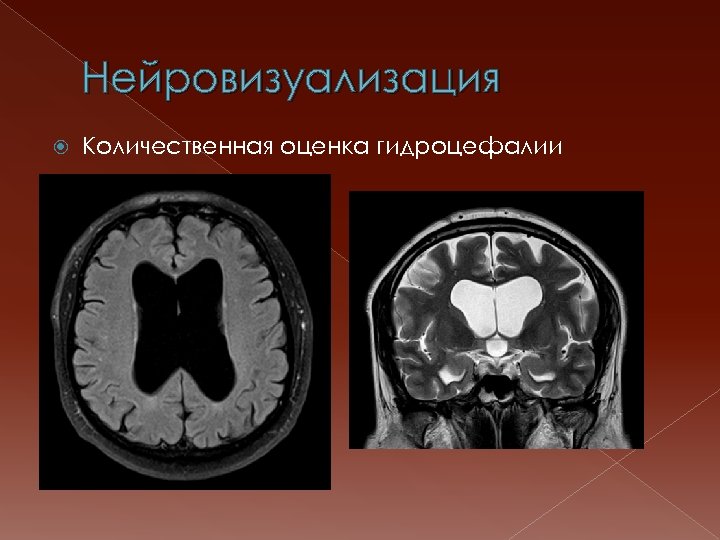 Нейровизуализация Количественная оценка гидроцефалии 