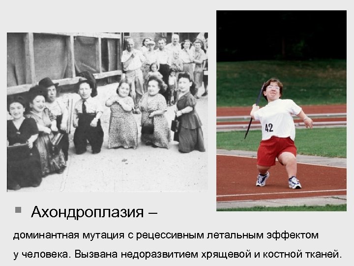 § Ахондроплазия – доминантная мутация с рецессивным летальным эффектом у человека. Вызвана недоразвитием хрящевой