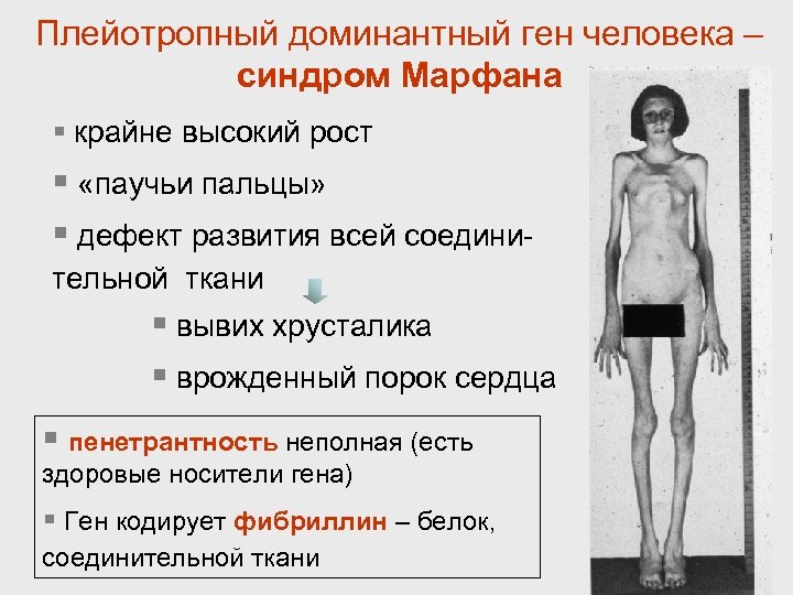 Плейотропный доминантный ген человека – синдром Марфана § крайне высокий рост § «паучьи пальцы»