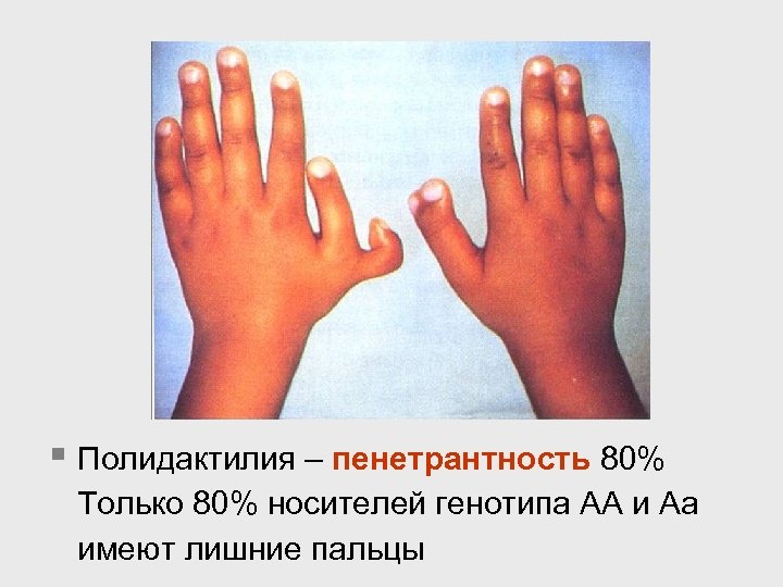 § Полидактилия – пенетрантность 80% Только 80% носителей генотипа АА и Аа имеют лишние