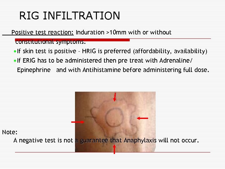 RIG INFILTRATION Positive test reaction: Induration >10 mm with or without constitutional symptoms. •