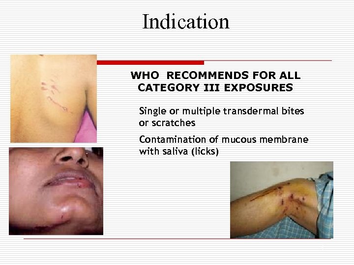 Indication WHO RECOMMENDS FOR ALL CATEGORY III EXPOSURES Single or multiple transdermal bites or