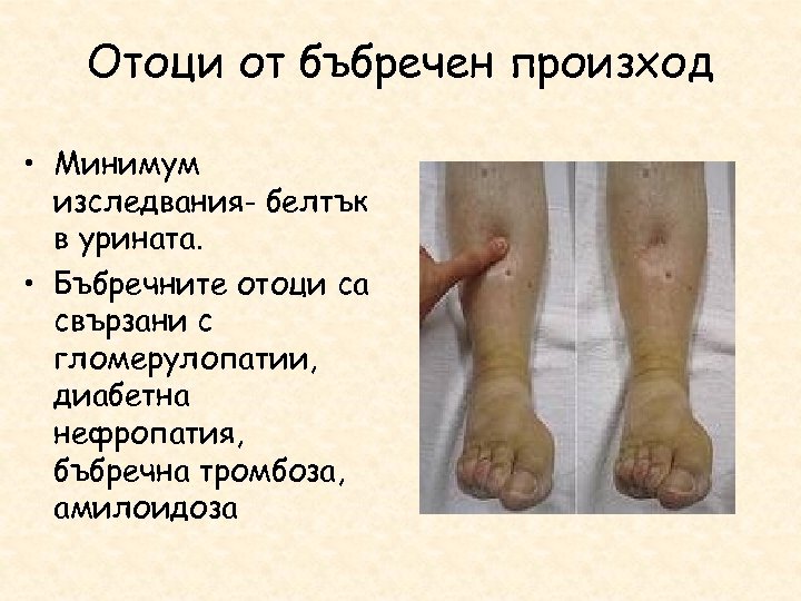 Отоци от бъбречен произход • Минимум изследвания- белтък в урината. • Бъбречните отоци са