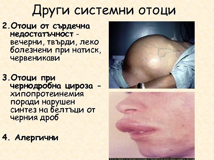 Други системни отоци 2. Отоци от сърдечна недостатъчност вечерни, твърди, леко болезнени при натиск,