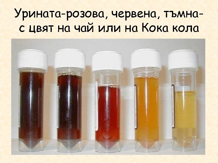Урината-розова, червена, тъмнас цвят на чай или на Кока кола 