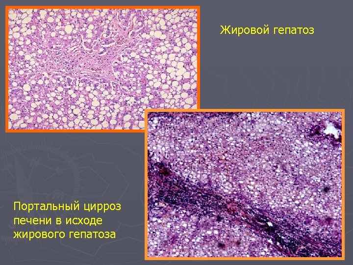 Жировой гепатоз презентация