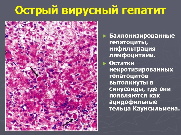 Гистологическая картина алкогольного гепатита