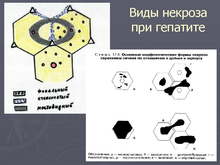 Виды некроза при гепатите 