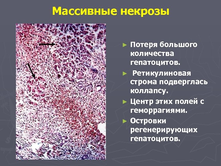 Массивные некрозы Потеря большого количества гепатоцитов. ► Ретикулиновая строма подверглась коллапсу. ► Центр этих