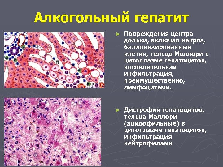 Алкогольный гепатит ► Повреждения центра дольки, включая некроз, баллонизированные клетки, тельца Маллори в цитоплазме