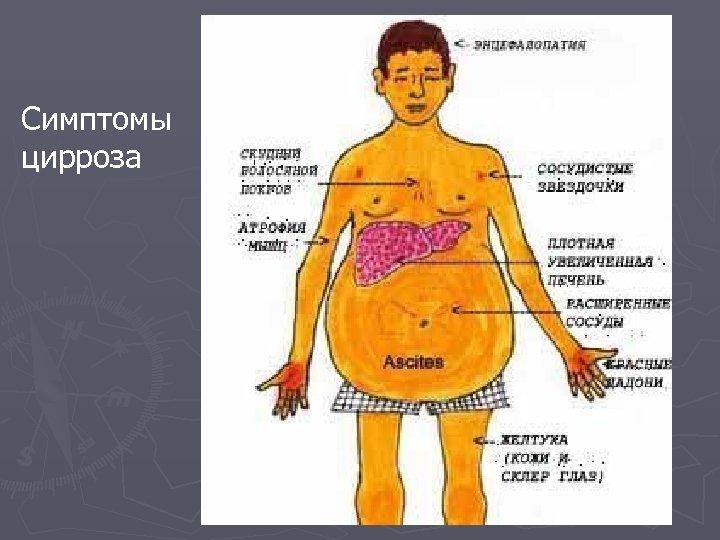 Симптомы цирроза 