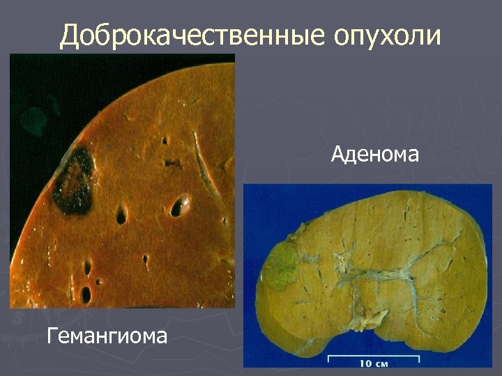 Доброкачественные опухоли Аденома Гемангиома 