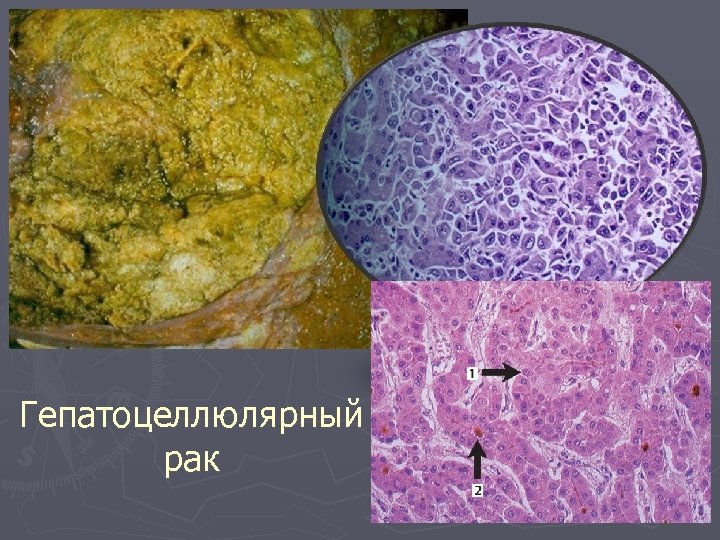 Гепатоцеллюлярный рак 