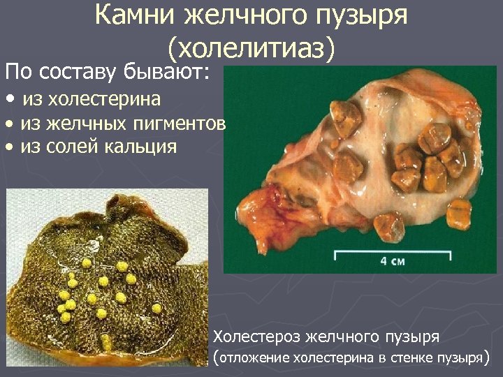 Камни желчного пузыря (холелитиаз) По составу бывают: • из холестерина • из желчных пигментов