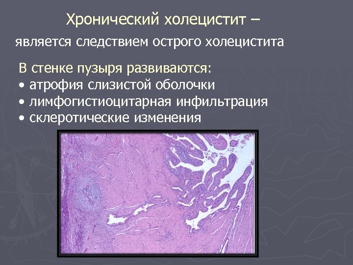 Хронический холецистит – является следствием острого холецистита В стенке пузыря развиваются: • атрофия слизистой