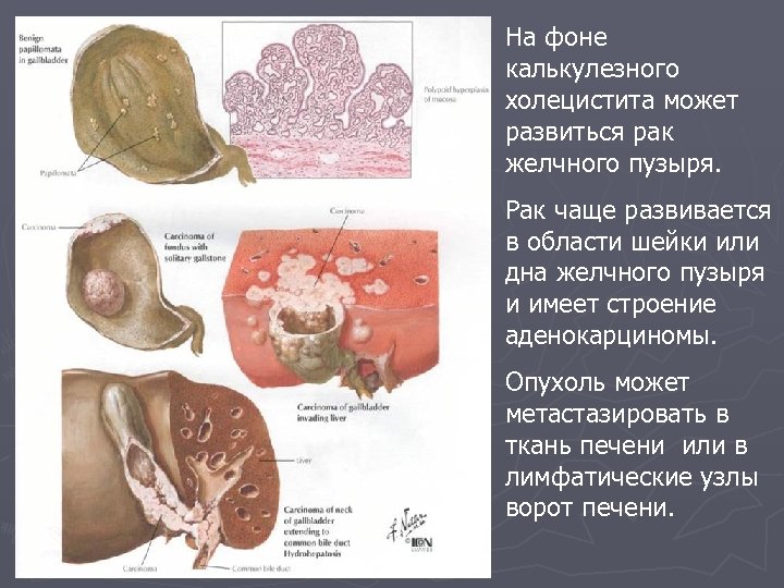 На фоне калькулезного холецистита может развиться рак желчного пузыря. Рак чаще развивается в области