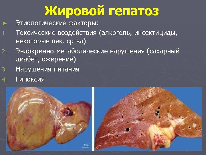 Жировой гепатоз ► 1. 2. 3. 4. Этиологические факторы: Токсические воздействия (алкоголь, инсектициды, некоторые