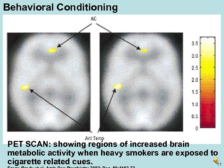 Behavioral Conditioning PET SCAN: showing regions of increased brain metabolic activity when heavy smokers