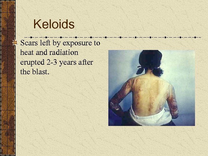 Keloids Scars left by exposure to heat and radiation erupted 2 -3 years after