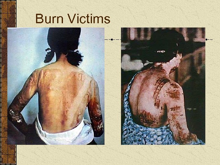 Burn Victims 