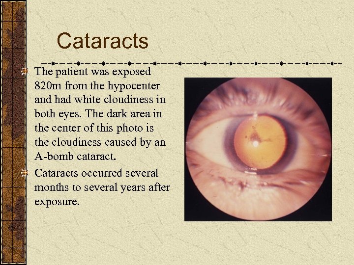 Cataracts The patient was exposed 820 m from the hypocenter and had white cloudiness