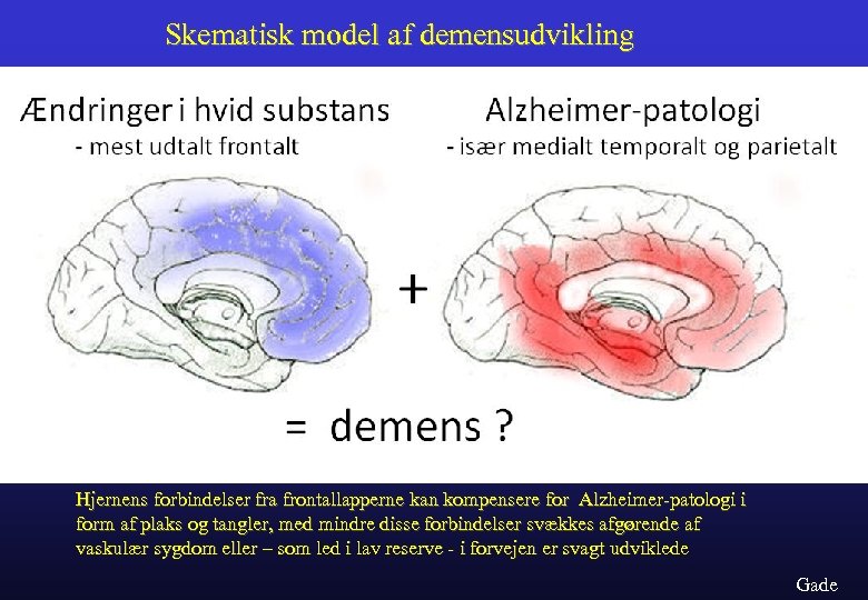 Skematisk model af demensudvikling Hjernens forbindelser fra frontallapperne kan kompensere for Alzheimer-patologi i form