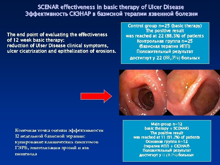 SCENAR effectiveness in basic therapy of Ulcer Disease Эффективность СКЭНАР в базисной терапии язвенной