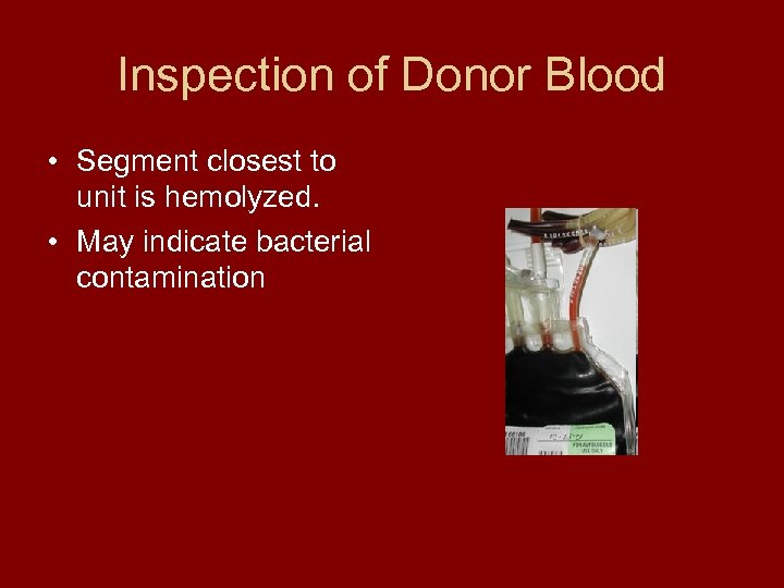 Inspection of Donor Blood • Segment closest to unit is hemolyzed. • May indicate