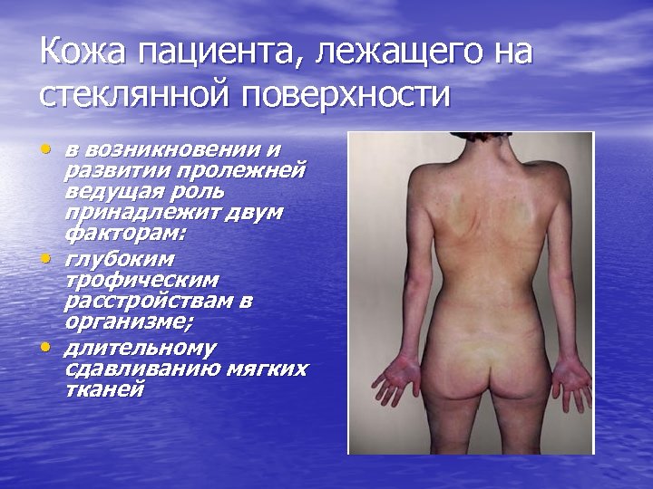 Кожа пациента, лежащего на стеклянной поверхности • в возникновении и развитии пролежней ведущая роль