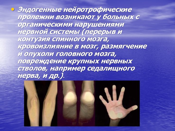  • Эндогенные нейротрофические пролежни возникают у больных с органическими нарушениями нервной системы (перерыв
