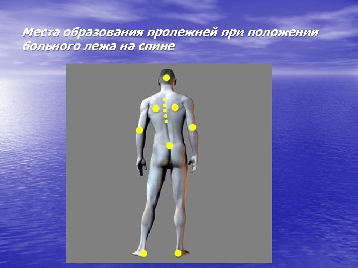 Места образования пролежней при положении больного лежа на спине 