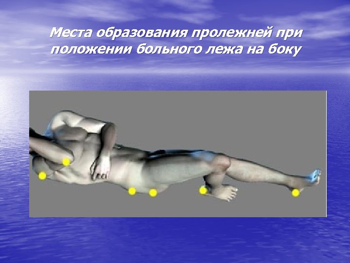 Места образования пролежней при положении больного лежа на боку 