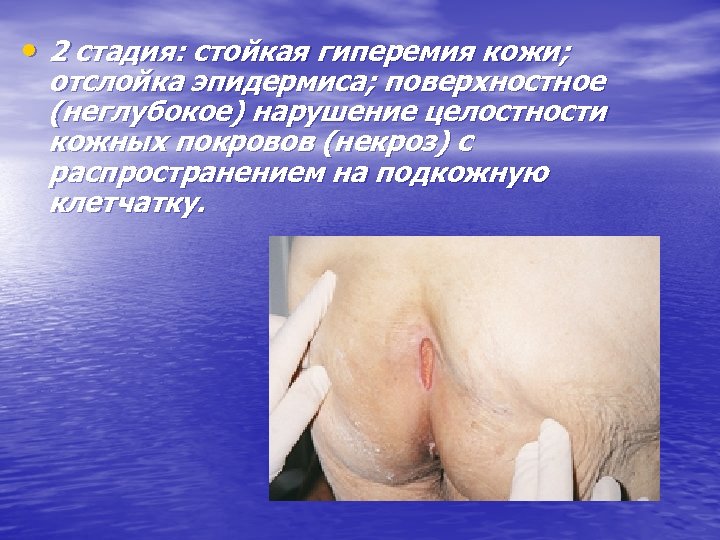  • 2 стадия: стойкая гиперемия кожи; отслойка эпидермиса; поверхностное (неглубокое) нарушение целостности кожных