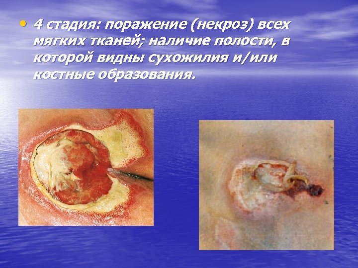  • 4 стадия: поражение (некроз) всех мягких тканей; наличие полости, в которой видны