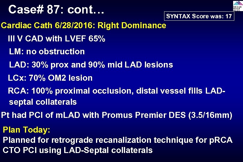 Case# 87: cont… SYNTAX Score was: 17 Cardiac Cath 6/28/2016: Right Dominance III V
