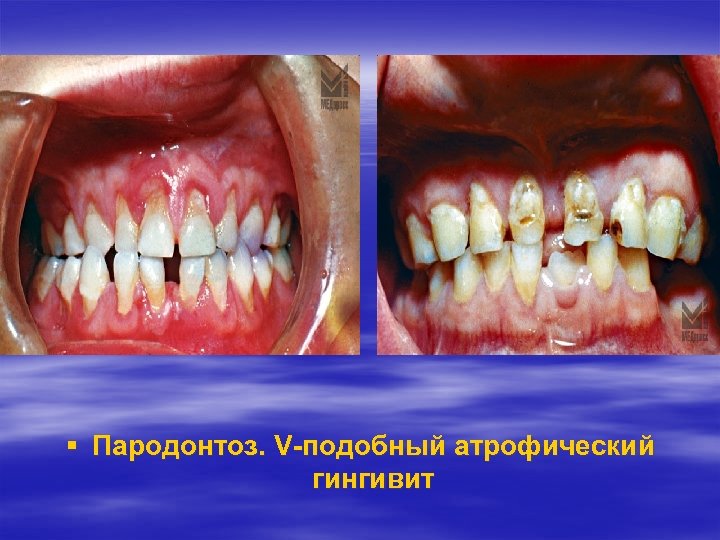  Пародонтоз. V-подобный атрофический гингивит 