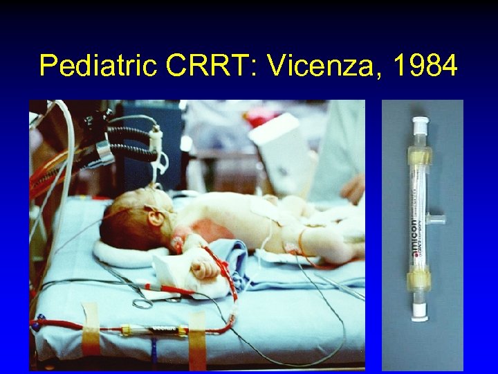 Pediatric CRRT: Vicenza, 1984 