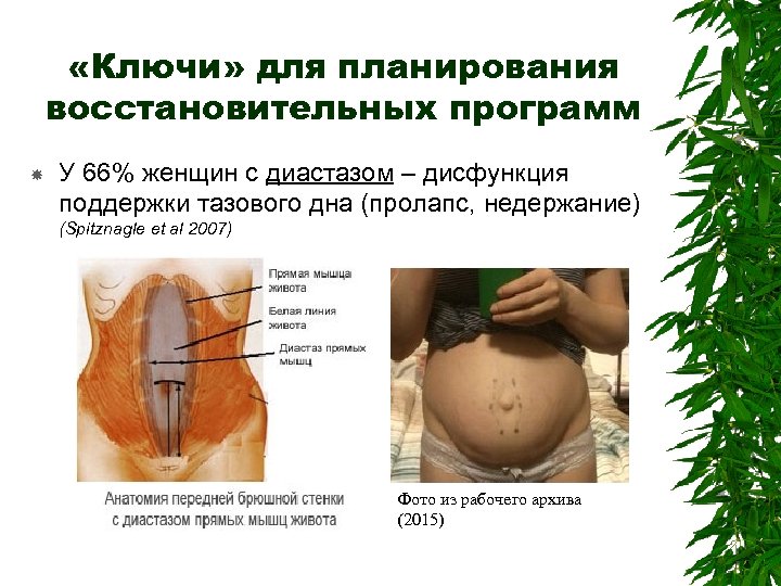  «Ключи» для планирования восстановительных программ У 66% женщин с диастазом – дисфункция поддержки