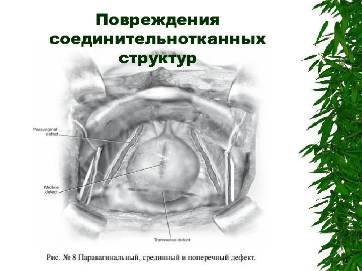 Повреждения соединительнотканных структур 