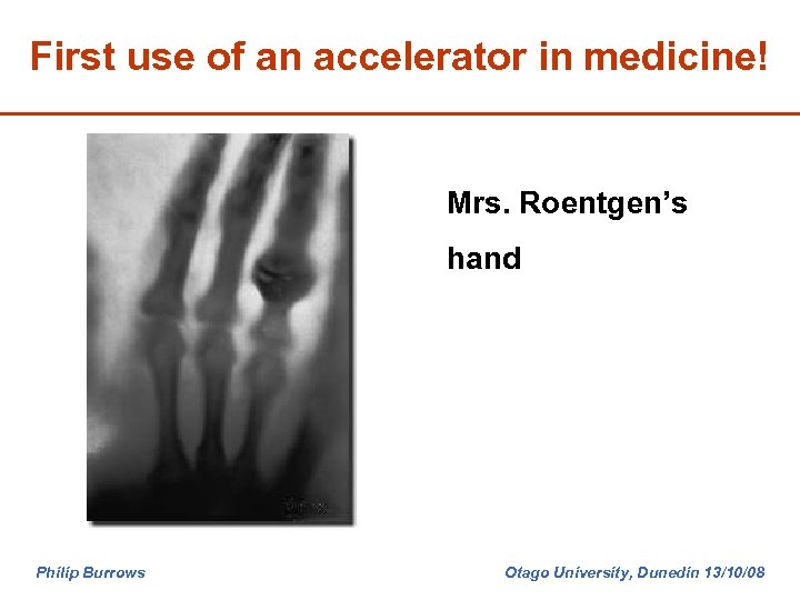 First use of an accelerator in medicine! Mrs. Roentgen’s hand Philip Burrows Otago University,