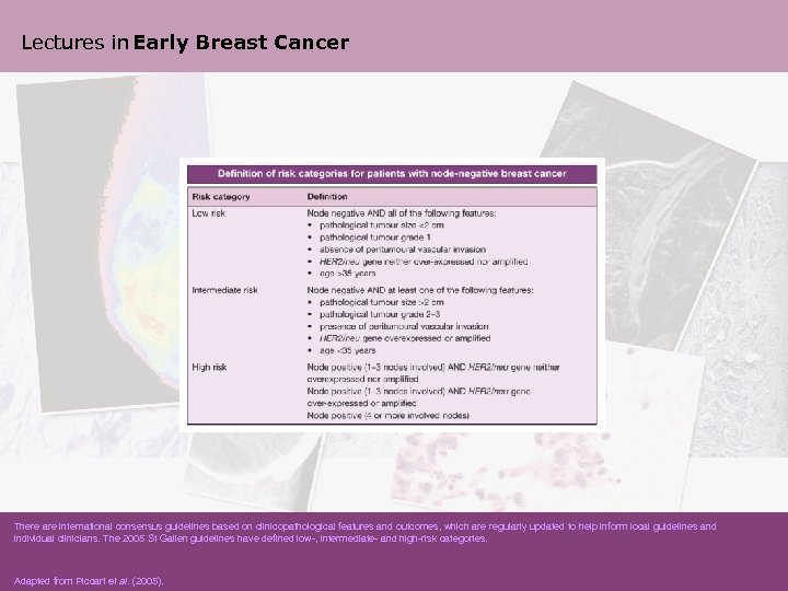 Lectures in Early Breast Cancer There are international consensus guidelines based on clinicopathological features