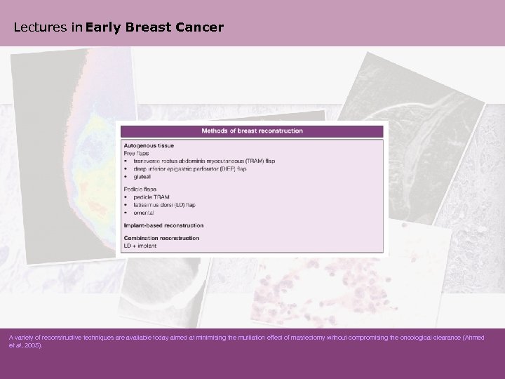 Lectures in Early Breast Cancer A variety of reconstructive techniques are available today aimed