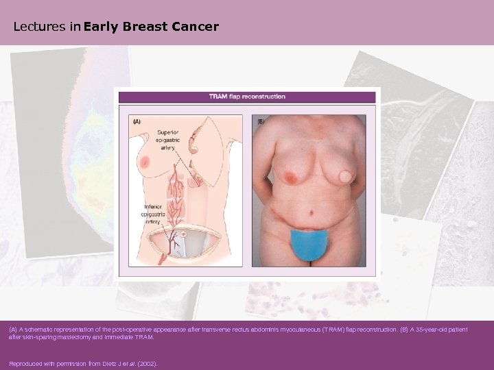 Lectures in Early Breast Cancer (A) A schematic representation of the post-operative appearance after