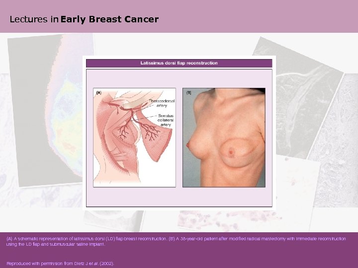 Lectures in Early Breast Cancer (A) A schematic representation of latissimus dorsi (LD) flap