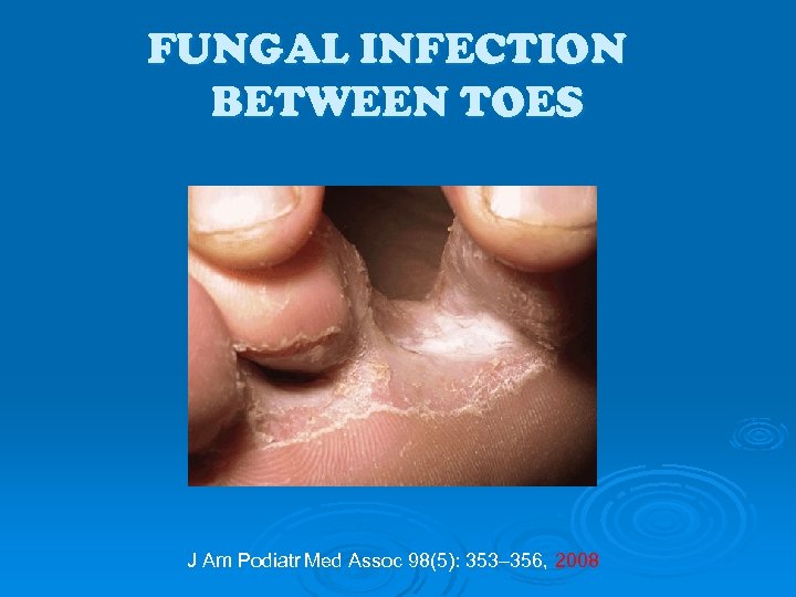 FUNGAL INFECTION BETWEEN TOES J Am Podiatr Med Assoc 98(5): 353– 356, 2008 