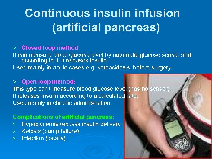 Continuous insulin infusion (artificial pancreas) Closed loop method: It can measure blood glucose level