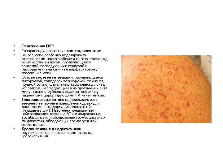  • • • Осложнения ГИТ: Гепарининдуцированные повреждения кожи: некроз кожи, особенно над жировыми