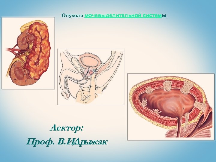 Опухоли мочевыделительной системы Лектор: Проф. В. И. ыжак Др 